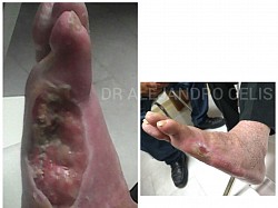 Manejo pie diabético