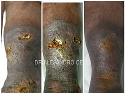 Manejo de úlceras venosas